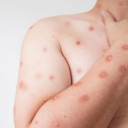 Monkeypox / Mpox : Quelles sont les nouvelles recommandations vaccinales ?